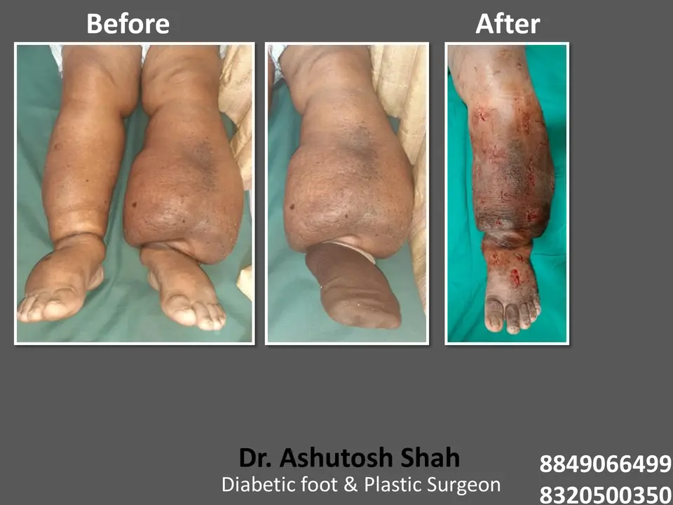 Diabetic Foot  PPT sunita.pptx-55.webp